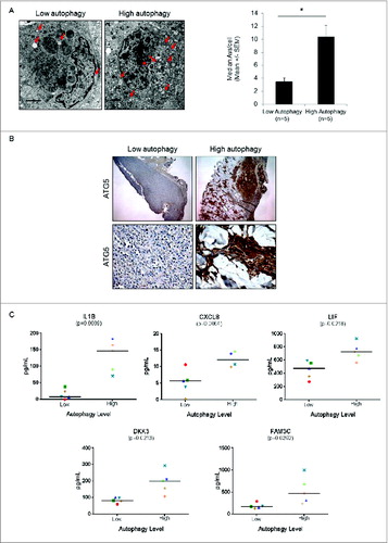 Figure 6. Measurement of autophagy candidate biomarkers in the serum of melanoma patients whose tumors have high or low autophagy. (A) Representative electron micrographs (left panels) and vesicle counts from patients with low- and high-autophagy melanoma tumors (right panel). Red arrows indicate tumor cell autophagic vacuoles. Scale bars = 2 μm. (B) Representative immunohistochemical staining of ATG5 (5X top, 40X bottom) in melanoma tumors from a patient with low and a patient with high tumor autophagy. (C) Measurement of CXCL8, IL1B, LIF, DKK3, and FAM3C by ELISA in serum of melanoma patients with either high or low levels of autophagy. Mean values are indicated by a horizontal line. P values were calculated using the Welch t test (N = 5 per group).