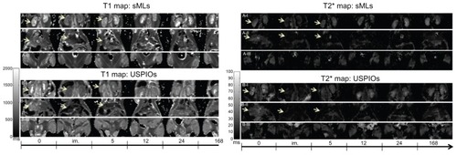 Figure 5 Behavior of the kidneys, liver, and muscle.Notes: Panels (A-I and B-I) display the signal behavior of the kidneys; panels (A-II and B-II) display the signal behavior of the liver; and panels (A-III and B-III) display the signal behavior of the muscle over time.Abbreviations: sMLs, steath magnetic liposomes; USPIOs, ultrasmall superparamagnetic iron oxides.