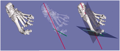 Figure 3. Three-dimensional evaluation of the affected foot. The severely pronated position of the proximal phalanx against the metatarsal (approximately 70° pronated) is evident.