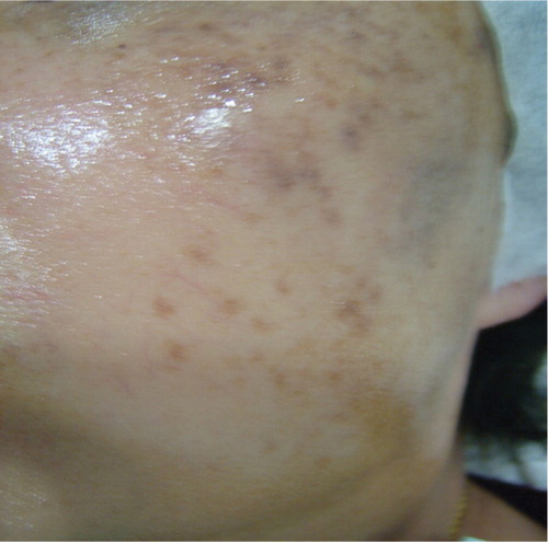 Figure 4 After the 12th laser session with three sessions of intravenous vitamin C.