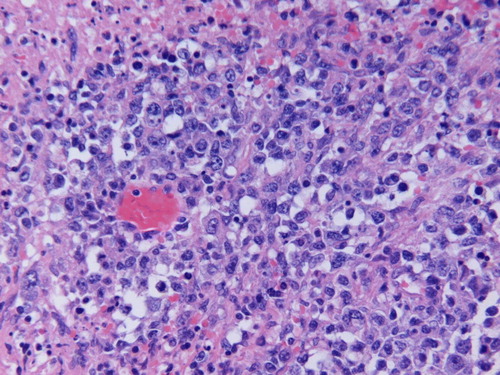 Figure 1.  H and E stained section showing the neoplastic lymphoid infiltrate composed of large cells with vesicular chromatin and single to several nucleoli resembling centroblasts and immunoblasts. Scattered apoptotic bodies, mitotic figures and pleomorphic cells are noted (original magnification×400).