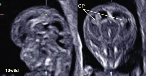Figure 15.  Sagittal section and coronal sections of 10-week-fetus CP; Choroid plexus of the lateral ventricles.