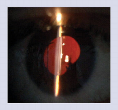 Figure 5. Anterior segment photograph of a patient with chronic convalescent phase of Vogt–Koyanagi–Harada disease shows a sunset glow ‘pupil’ appearance and posterior synechiae.