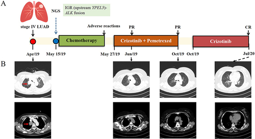 Figure 1 Schematic of patients’ treatment histories. (A) The treatment timeline of the patient. (B) Images of the chest CT are provided with lung tumors indicated with red arrows.