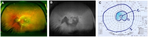 Figure 2 Case 2: (A and B) Optomap color fundus imaging (A) and wide-field FAF (B) of the right eye. (C) Corresponding visual field measured with Goldmann manual perimetry.