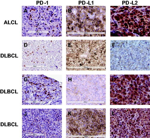 Figure 3. Immunohistochemical stainings of PD-1, PD-L1, and PD-L2 in PTLD. First row: Anaplastic large cell lymphoma (ALCL) positive in all three stainings, with a membranous staining pattern for PD-1(A) and PD-L1 (B), and a cytoplasmic and nuclear pattern for PD-L2 (C); Second row: Diffuse large B-cell lymphoma (DLBCL) of non-germinal center (non-GC) type with a membranous staining pattern for PD-1 (D) and PD-L1 (E), but negative for PD-L2 (F); Third row: DLBCL of GC type positive for PD-1 in a membranous pattern (G), with <5% of the tumor cells positive for PD-L1, therefore regarded as PD-L1 negative (H), but PD-L2 positive in a cytoplasmic and nuclear pattern (I); Fourth row: DLBCL of non-GC type negative for PD-1 (J), but positive for PD-L1 in a membranous (K) and PD-L2 in a cytoplasmic pattern (L).