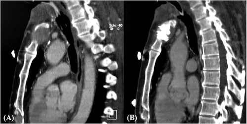 Figure 1 (A) A CT sagittal image demonstrated an osteolytic metastatic lesion in the sternal manubrium with anterior and posterior cortical disruption. (B) A CT sagittal image demonstrated a good cement distribution in the lesion and a slight leakage along the posterior cortical margin.