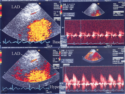 Figure 1 Mid‐ to distal segment of the left anterior descending (LAD) coronary artery in color‐coded transthoracic Doppler echocardiography, spectral Doppler coronary blood flow by sampling in mid‐ to distal segment of the LAD.