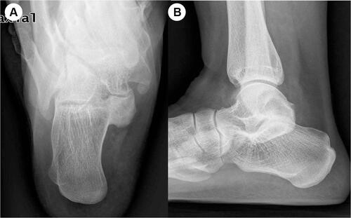 Figure 9 (A and B) Talocalcaneal coalition in a patient with chronic ankle instability.