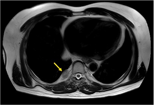 Figure 5 T2W/TSE sagittal MRI image 1 month after the completion of all the treatments, showing no considerable change in the size of the right pleural lesion (yellow arrow).Abbreviations: MRI, magnetic resonance imaging; T2W/TSE, T2 weighted/turbo spin echo.