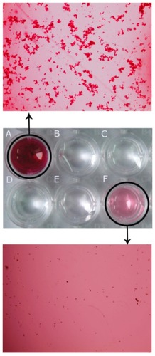 Figure 2 PAS staining to confirm the formation of mannan-modified adenovirus. The different groups subjected to PAS staining are medium-free mannan (A), PAS reagent (B), free Ad5 (C), low mannan-modified Ad5 (D), medium mannanmodified Ad5 (E), and high mannan-modified Ad5 (F), respectively. Mannan of different concentrations was conjugated to adenovirus as described in the Materials and methods section, and then the conjugates were subjected to PAS assay. At the same time, PAS reagent alone was used as the negative control. Both well (A) and well (F) were further observed under light microscopy (100×).Abbreviations: PAS, periodic acid Schiff; Man, mannan; Ad5, recombinant adenovirus using the PTEN gene; PTEN, phosphatase and tensin homolog deleted on chromosome ten.