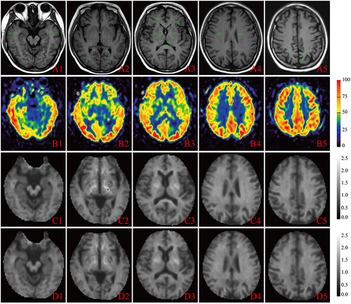 Figure 1 Representative images and measurements within 25 brain regions of a non-NPSLE patient. A1–5, T1WI, level of RIOs in different brain regions; B1–5, CBF, cerebral blood flow (in unit mL/100g/min); C1–5, MK, mean kurtosis; D1–5, MKT, mean kurtosis tensor. The temporal lobe ROIs were selected at the level of the transcerebral horn in the region of the middle temporal gyrus. The frontal lobe ROIs were selected in the region of the middle and inferior frontal gyrus at the level where the distance between the anterior horns of the bilateral lateral ventricles was greatest. The occipital lobe ROIs were selected as the posterior occipital region at the level of the lateral ventricular triangle. The parietal lobe ROIs were selected from the precuneus region in axial section through the cingulate gyrus. The caudate nucleus, thalamus, and lenticular nucleus (LN) ROIs were chosen to be outlined in the corresponding brain regions of the inner capsule in a better section, and the splenium of the corpus callosum (SCC) ROIs were chosen to be outlined in the near midline region at the same level. The semioval center (SOC) ROIs were located in the white matter area adjacent to the body of the lateral ventricle at the upper level.