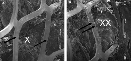 Figure 8.  Scanning electron microphotography of the luminal surface of the most proximal segment of the Module B implanted for 12 days. It shows the bare stent (single arrows) and with some minor blood debris (double arrows) above the polyester impregnated with a thrombotic matrix that makes the prosthetic wall impervious to blood percolating (A*;B**) (A:×23) (B:×23).
