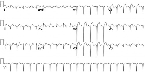 Figure 3 ECG, sinus tachycardia with ST waves elevation and pathologic Q waves in the anterolateral leads.