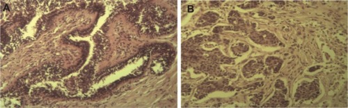 Figure 1 Histopathological sections of the original tumor of which the AMJ13 cell line was derived from.