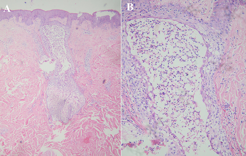 Figure 2 (A) Mild edema of epidermal acanthocytes and a large number of eosinophils and a small number of neutrophil lymphocyte-dominated infiltrates around the hair follicle sebaceous gland in the dermis (HE×200x) (B) Eosinophil-formed abscess in the hair follicle and a small number of inflammatory cell infiltrates around the superficial dermal vessels (HE×400).
