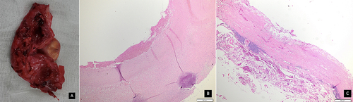 Figure 5 Excised pseudoaneurysm and histological pictures of pseudoaneurysm and aneurysm: (A) An excised draining vein pseudoaneurysm; (B) Pseudoaneurysm histological examination showed a faint vascular appearance with numerous necrotic cells, hemosiderin deposits, macrophages, and stromal fibro-collagen tissue partially hyalinized with massive scattering of inflammatory cells, including lymphocytes, polymorphonuclear leukocytes, and eosinophils; (C) Aneurysm histological examination showed the tunica intima with a completely erosive endothelium and a fibro-collagenous fibrous connective tissue stroma covered with inflammatory cells, lymphocytes, and histiocytes; the tunica media is composed of partially fibrotic muscle cells with a normal nucleus; and the tunica serosa consists of connective tissue accompanied by mature adipose tissue with a normal nucleus.