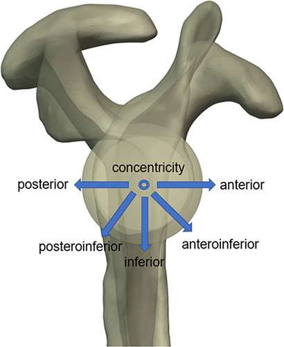 Figure 1 This figure shows 6 different glenosphere eccentricities positions (concentricity, +2 mm inferior, +2 mm posterior, +2 mm anterior, +2 mm anteroinferior, and +2 mm posteroinferior) with no change in the baseplate.