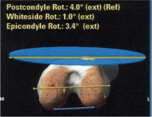 Figure 2. The position of the femoral component, showing the calculated position relative to the rotation axis. [Color version available online.]