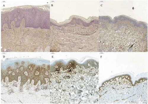Figure 3. Hyaluronan (HA) and CD44 staining of skin biopsies of active psoriatic arthritis before and after 12 weeks of treatment with adalimumab. (A–C) HA staining (brown); (D–F) CD44 staining (brown). (A, D) Before treatment; (B, E) after 3 months’ treatment with adalimumab; (C, F) healthy skin. After treatment, the epidermal thickness had reduced to normal. There were no distinct differences in staining intensity in either HA or CD44 before or after treatment. HA stained in all skin layers.