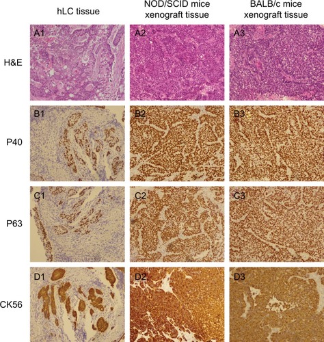 Figure 2 Comparison of building PDX models in NOD/SCID mice and BABL/c mice with the corresponding squamous cancer patient.Notes: (A1) H&E staining of human lung cancer tissue; (A2) H&E staining of NOD/SCID mice xenograft tissue; (A3) H&E staining of BALB/c mice xenograft tissue; (B1) P40 staining of human lung cancer tissue; (B2) P40 staining of NOD/SCID mice xenograft tissue; (B3) P40 staining of BALB/c mice xenograft tissue; (C1) P63 staining of human lung cancer tissue; (C2) P63 staining of NOD/SCID mice xenograft tissue; (C3) P63 staining of BALB/c mice xenograft tissue; (D1) CK56 staining of human lung cancer tissue; (D2) CK56 staining of NOD/SCID mice xenograft tissue; (D3) CK56 staining of BALB/c mice xenograft tissue. Magnification ×100.Abbreviations: hLC, human lung cancer; PDX, patient-derived tumor xenografts.