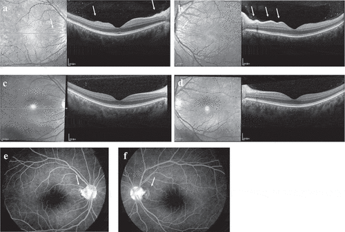 Figure 2. (a–b) OCT also showed radial retinal wrinkles (white arrows) at presentation, (c–d) which then disappeared one month after presentation. (e–f) FA revealed optic disc swelling (white arrows) and macular edema OU at presentation.