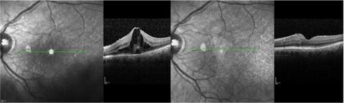 Figure 3 Patient with acute pseudophakic ME before nepafenac administration and after 4 months therapy. Visual acuity elevated from 0.44 logMAR to 0.30 logMAR, and central macular thickness decreased from 601 μm to 379 μm. Green line represents the same area of the fovea prior to and after therapy in infrared picture, which corresponds to CME improvement.