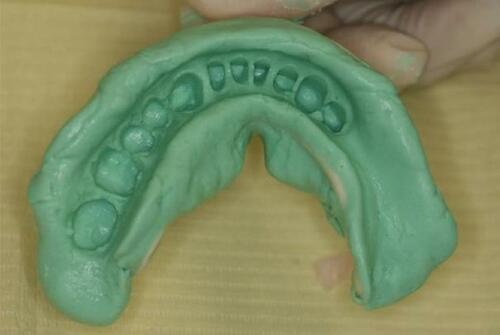 Figure 9 Mandibular irreversible hydrocolloid impression.