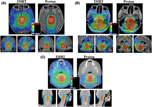 Figure 2. (A) Patient 1 axial (top) and coronal, sagittal (bottom) isodose distribution. (B) Patient 2 axial (top) and coronal, sagittal (bottom) isodose distribution. (C) Patient 3 axial (top) and coronal, sagittal (bottom) isodose distribution.