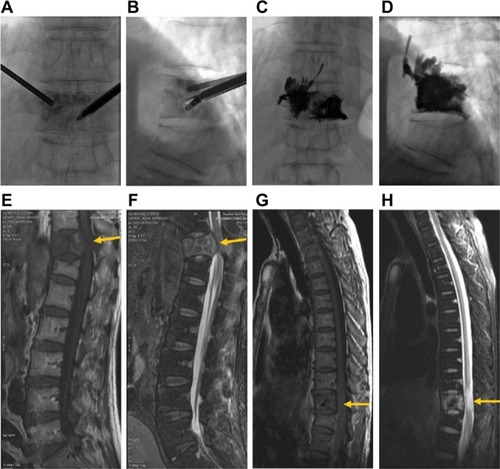 Figure 2 Group A: malignant vertebral compression fracture of T11 vertebra owing to metastasis from prostate cancer in a 63-year-old male patient with spinal pain and symptom of neurologic compression prior to the procedure.