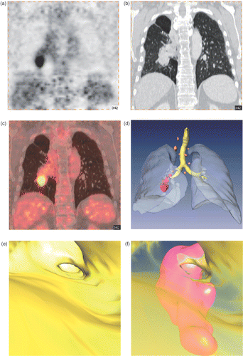 Figure 1. A 68-year-old woman with a non-small cell lung cancer (NSCLC) in the right lower lobe and mediastinal lymph node metastases. (a–c) Coronal view, showing a CT-based attenuation-corrected 18F-FDG PET image (a), a venous-dominant contrast-enhanced diagnostic CT image (b), and the PET/CT image (c). 18F-FDG PET and CT show the NSCLC in the caudal region of the right hilus. (d–f) Image postprocessing, showing a color-coded shaded-surface rendering model of the tracheobronchial system (yellow), the NSCLC (red) and the mediastinal lymph node metastases (orange), and a volume rendering model of the thorax (transparent, gray) (d); and virtual hybrid bronchoscopic views (e, f) of the right lower lobe bronchus, showing the NSCLC (red) in the transparent color-coded shaded-surface model (f). The tracheobronchial system was segmented using the CT data set. The bronchial carcinoma and the lymph node metastases were segmented using the PET data set. [Color version available online.]
