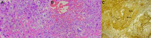 Figure 3 Hematoxylin and eosin staining of a tumor section (×200). (A) Pathological examination under light microscopy, showing a poorly differentiated non-small cell carcinoma occupying the space of the upper lobe of the left lung. (B) Pathological examination under light microscopy, showing a poorly differentiated carcinoma of the right breast with extensive hemorrhagic necrosis. (C) Immunohistochemical staining for β-hCG (positive in foci).