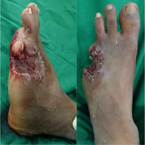 Fig. 4 Inset of a split-thickness skin graft onto remaining surgical wound defect secured using surgical staples.