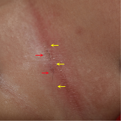 Figure 1 A black linear lesion was noted in the neck folds. It included a total of five segments. Three segments (yellow arrows) were embedded in the skin, and the rest (red arrows) of the strand exposed. It looked like a snake, and there was no erythematosus nor papules around it.