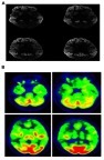 Figure 1 (A) Brain diffusion-weighted-MRI of the proband patient. (B) FDG PET imaging of proband patient.