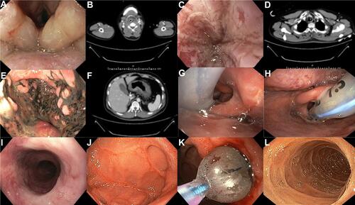 Figure 1 The endoscopic findings and computerized tomography (CT) scan of corrosive injury. A 24-year old Thai male patient with ingested toilet cleaning agent was admitted and evaluated by endoscopy and CT scan in the COVID-19 pandemic. (A and B) The oropharynx, hypopharynx, and larynx demonstrated edema and wall thickening. (C and D) The esophageal lumen showed Zargar 2a with a whitish membrane, erosion, without periesophageal soft tissue infiltration. (E and F) The stomach revealed Zargar 3a with edematous wall thickening plus scattered brown-black areas with mild perigastric soft tissue infiltration without fluid collection. He was treated by orotracheal intubation with ventilation support in the surgical intensive care unit. The parenteral nutrition gave and a closed clinical monitor. (G and H) After the situation improved, the laryngo-bronchial was evaluated, and the patient was successfully extubated. (I and J) Four weeks after corrosive ingestion, the patient demonstrated scar formed without stricture of esophagus and fibrotic scar of stomach with a pyloric stricture. (K and L) A patient was treated by endoscopic balloon dilation and steroid injection every 1–2 weeks. Finally, the endoscopy could be pass to the duodenum with successive clinical improvement.