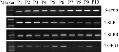 Figure 6 Increased expression of TSLP, TSLPR, and TGFβ1 mRNA in HPV-positive patients. Using RT-PCR, mRNA levels of β-actin TSLP, TSLPR, and TGFβ1 were detected in oropharyngeal tissue of HPV-positive and HPV-negative patients. Error bars indicate SEM. P < 0.05 (Student’s t-test).