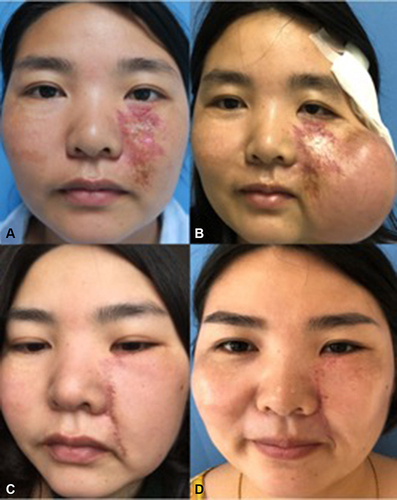 Figure 3 Case 3. A 32-year-old female had PWS with obvious scars and pigment anomalies in the left face after superficial radiotherapy and cryotherapy. The tissue expander (rated capacity:100mL) was placed adjacent to the lesion in left cheek in the first-stage surgery. Regular expansion lasted for 93 days with a final capacity of 252mL. The lesion was removed and repaired by the expanded flap in the second-stage operation. The flap survived well. (A and B) Preoperative views. (C and D) Postoperative views one year later. Evaluation result was “very satisfied (score of 5)”.
