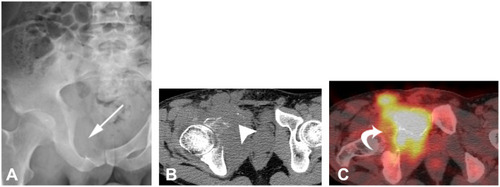 Figure 11 Bone metastases of NSGCT in a patient presenting with seminoma and PET-avid osseous metastasis. (A) Pelvic radiography showing geographic lytic lesion involving right superior pubic ramus. (B and C) Axial CT of pelvis showing geographic mass lesion with soft-tissue component involving superior pubic ramus with corresponding increased FDG avidity.