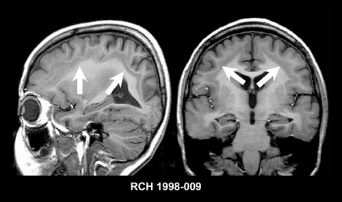 Figure 6. Imaging features of subcortical band heterotopia. Sagittal (left) and coronal (right) T1-weighted MRIs showing typical features of subcortical band heterotopia with bilateral, symmetric band of tissue with identical signal to cortical gray matter interspersed in the subcortical white matter between the normal cortex and the lateral ventricle. MRI, magnetic resonance imaging
