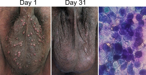 Figure 2 Clinical manifestation of molluscum contagiosum on genital area before and after 20% KOH (left side) and 80% TCA (right side) treatment. Basophilic, round, and anucleated masses (Henderson–Paterson bodies) were using Giemsa staining. All of the MC lesions disappeared on day 31 and leaved post-inflammatory hypopigmentation after treatment.