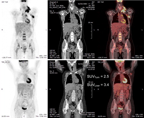 Figure 1. Top: baseline PET/CT in a patient with DLBCL. Bottom: PET/CT after two cycles of R-CHOP; residual uptake in the left axillary lymph node which seems visually equal to or greater than the liver uptake. On the right the SUVmax of the lymph node is lower than the liver SUVmax.