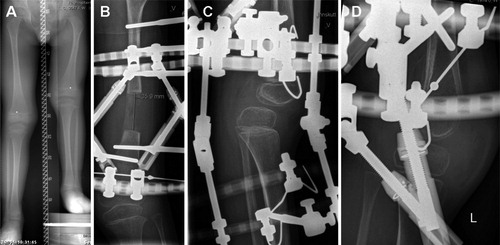 Figure 2. A 6-year-old boy with congenital femoral deficiency and fibular hemimelia (panel A). After 3.5 cm of lengthening, subluxation of the knee was observed, although the knee was transfixated by a hinged frame (B and C). Hinges were replaced by TSF struts and the knee was gradually reduced to anatomical position (D). As a sequela, the patient suffers from reduced range of motion in the knee. At the latest follow-up, range of motion was from −5° extension to 50° of flexion with slow but continuous improvement.