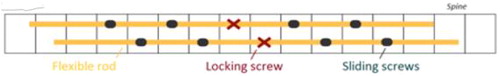 Figure 1. Implantation scheme of the spine. The spine were then implanted with 10 bicortical pedicle screws, in quincunx using on each side 4 sliding pedicle screws and 1 fixed pedicle screw at the centre of the construct. A 5.5 mm PEEK flexible rod (SP group) or a 5.5 mm titanium rod (ST group) was then inserted into the screws.