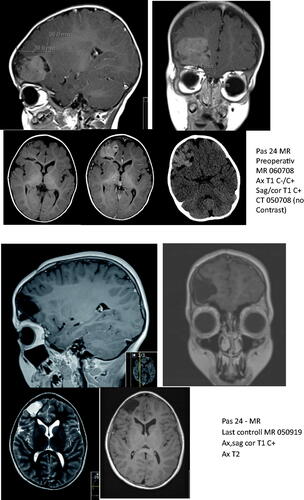 Figure 1. Nine-month-old boy presenting with epileptic seizure (patient number 24, Table 1). After GTR of WHO grade 2 ependymoma in the right frontal region, no adjuvant treatment was given. The clinical and radiological situation has been uneventful for 11 years.