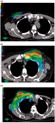 Figure 2. (a) WBI: dose color wash indicating 90% isodose. (b) Loco-regional RT: axillary level 1 not included; dose color wash indicating 90% isodose. (c) Loco-regional RT: axillary level 1 included; dose color wash indicating 90% isodose.