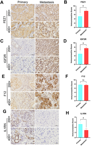 Figure 10 Expression levels of FEZ1, F12, IGF2R and IL1RN in breast cancers by IHC. (A, C, E and G) Expression of FEZ1, F12, IGF2R and IL1RN, respectively in primary (n = 12) and metastasis (n = 12) breast cancer tissue (SPx400). (B, D, F and H) Typical IHC images obtained at a 400× magnification together with IRS were used for analyzing the IHC results of FEZ1, F12, IGF2R and IL1RN, respectively, in primary breast cancer (n = 12) and metastasis (n = 12) samples. (mean ± SEM, *P < 0.05).