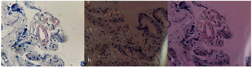 Figure: (a) Congo red-stained duodenal biopsy of small vessels. (b and c) Polarized light microscopy showing green birefringence of amyloid deposits in the vessels.