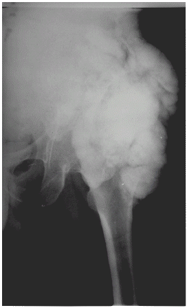 Figure 2. X-ray showing extensive periarticular calcification involving soft tissue around left hip.