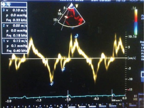 Figure 3 Abnormal RV S’, 0.10m/s in subjects with HF.